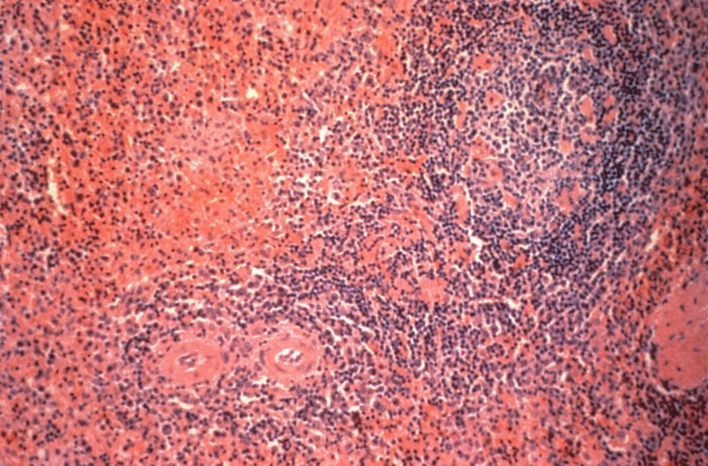 Liver cirrhosis awareness